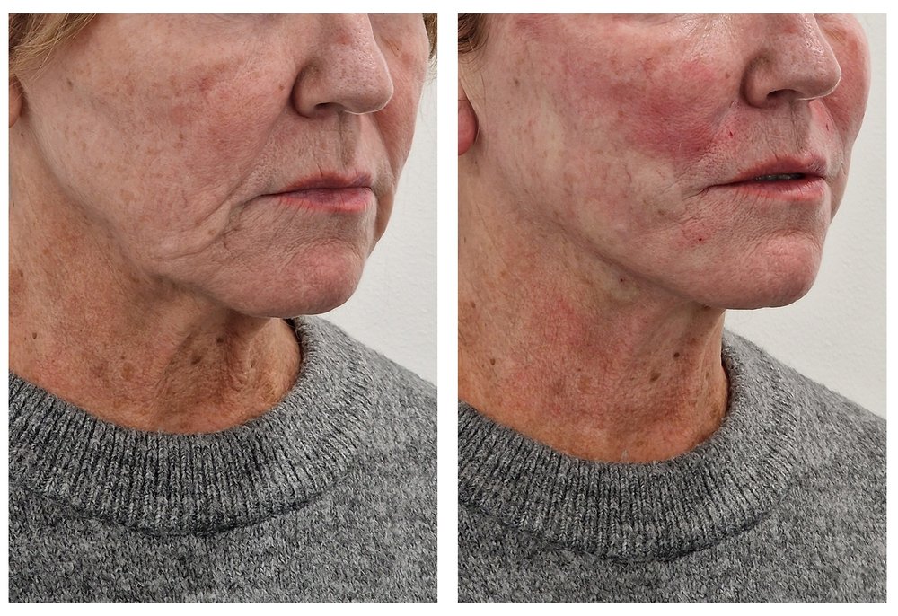 Q-Lift Ultimate before and after — jawline and neck definition, side profile