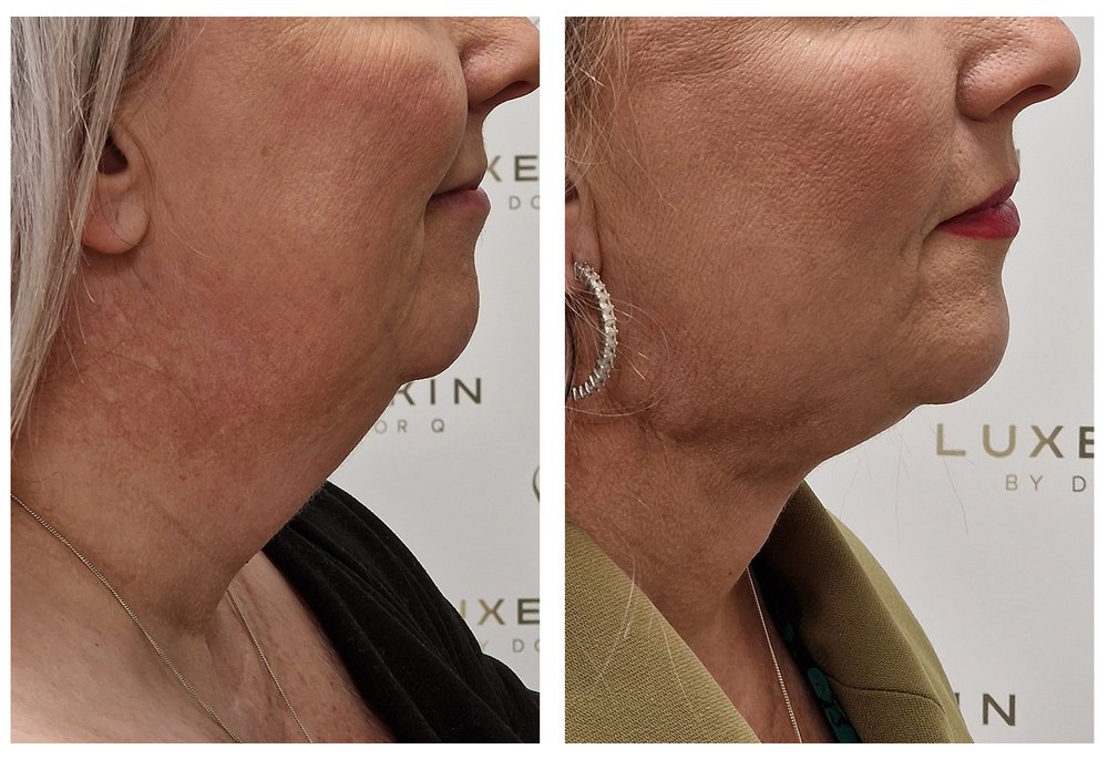 Q-Lift Ultimate before and after — full face lift