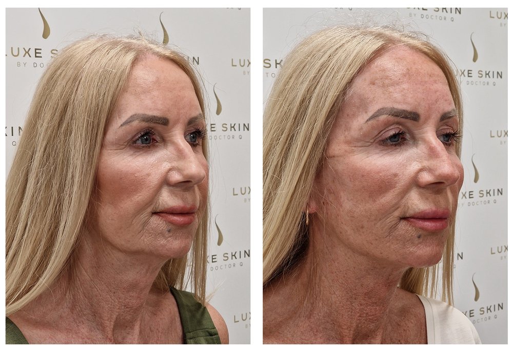 Q-Lift Ultimate before and after — mature patient profile with skin renewal