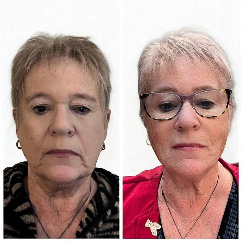 Q-Lift Ultimate before and after — facelift without neck lift