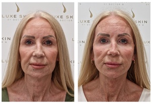 Q-Lift Ultimate before and after — dramatic full-face transformation