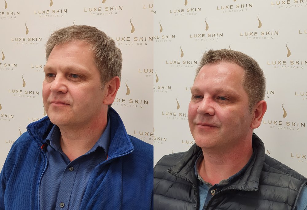 Q-Lift Ultimate before and after — male patient, jawline and jowl definition