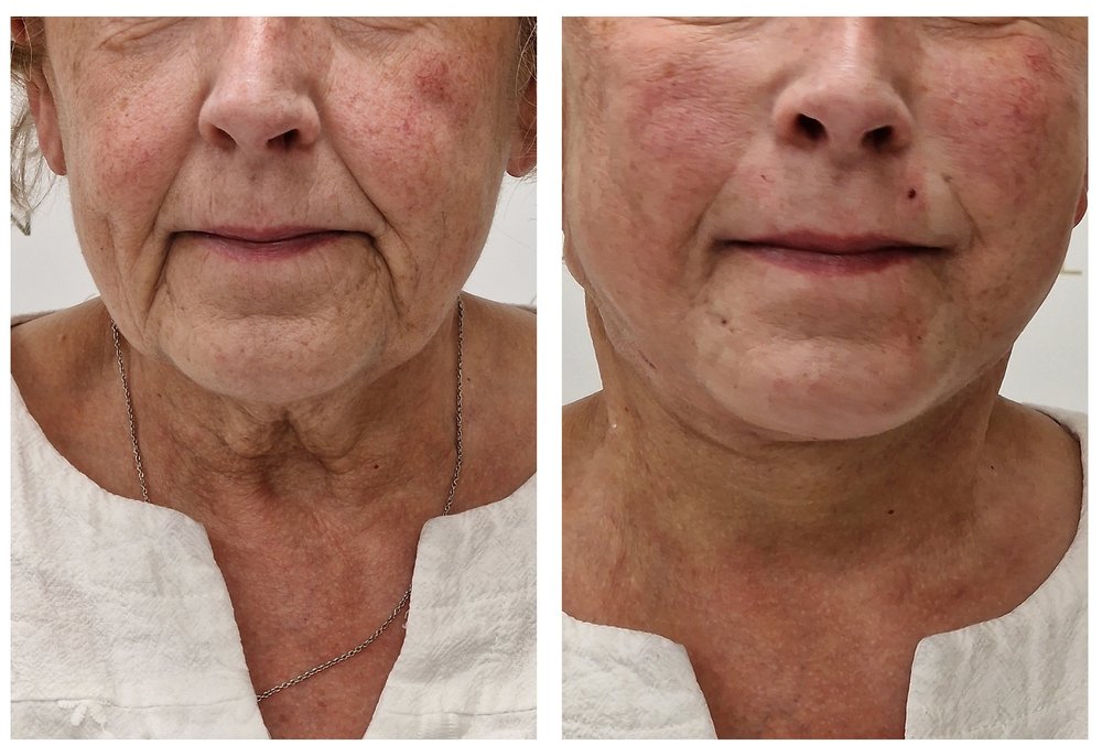 Q-Lift Ultimate before and after — neck and lower face, profile view