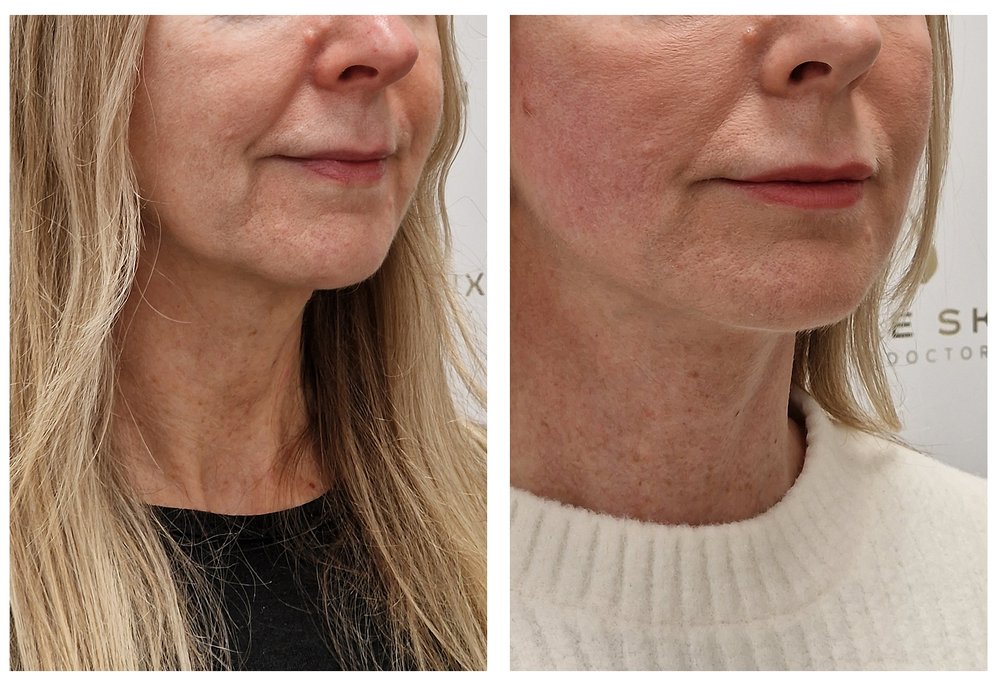 Q-Lift Ultimate before and after — mature patient neck rejuvenation