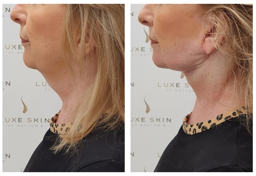 Q-Lift Ultimate before and after — jawline profile correction