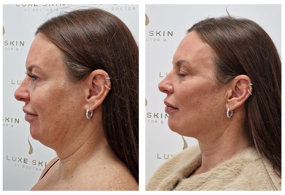 Q-Lift Ultimate before and after — mid-face and jowl lift, side profile