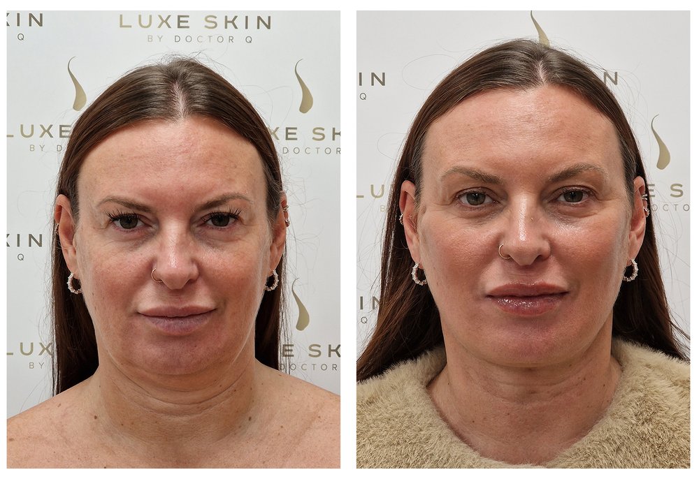 Q-Lift Ultimate before and after — complete facial rejuvenation