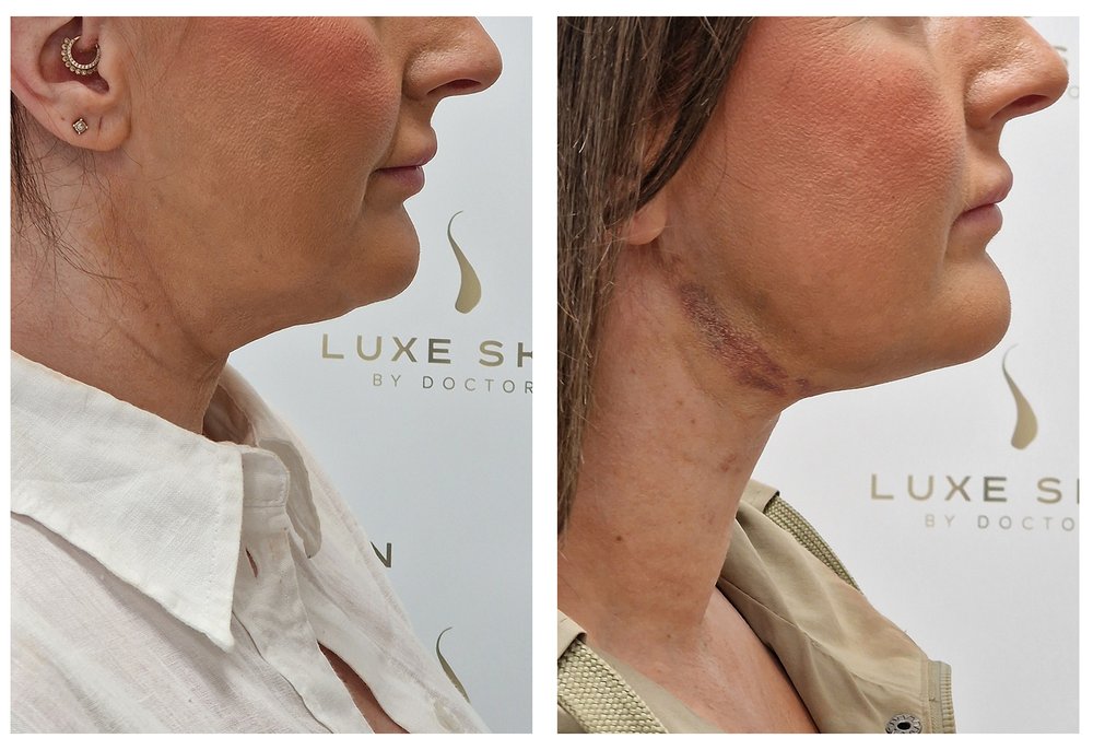 Q-Lift Ultimate before and after — cheek definition and eye area