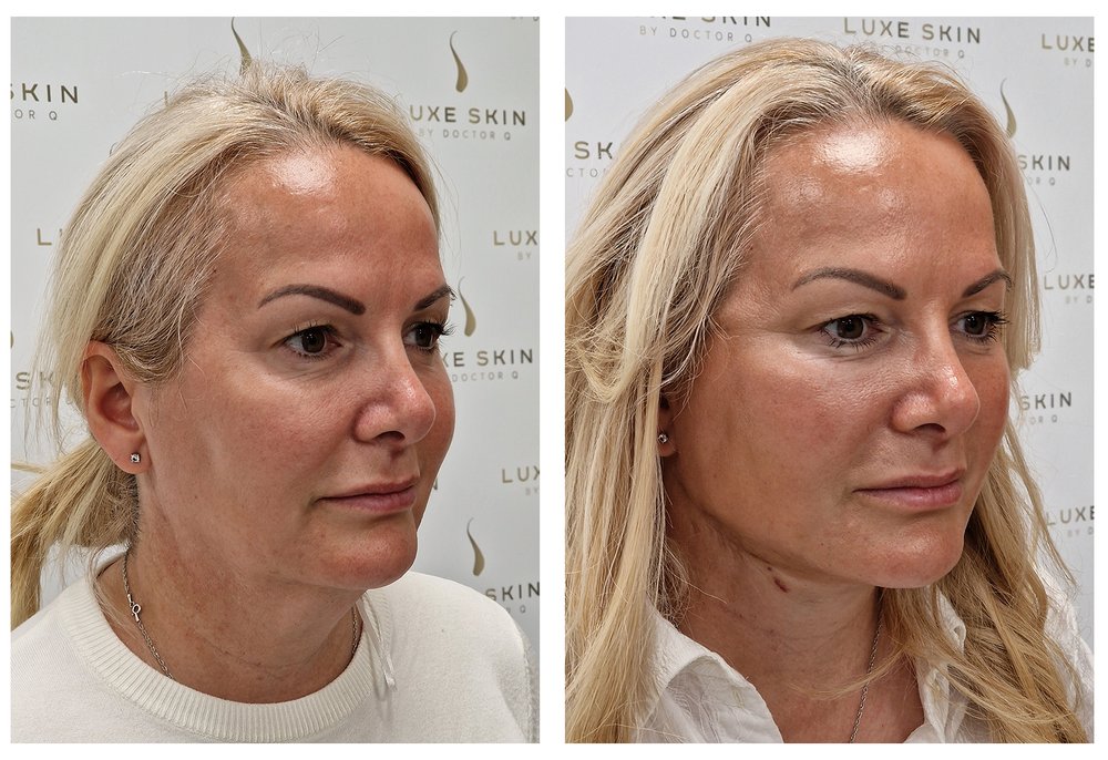 Q-Lift Ultimate before and after — jawline return and facial contour